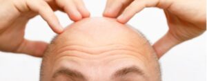 De juiste kandidaat voor een haartransplantatie behandeling?