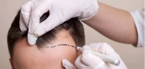 De beste leeftijd voor een ​​haartransplantatie?