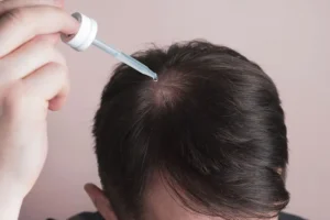 Minoxidil een wondermiddel?