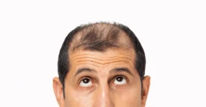 Is een haartransplantatie gevaarlijk?