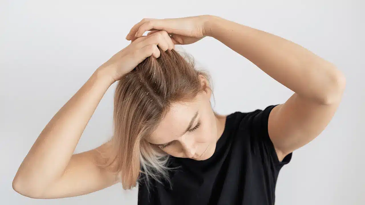 jeukende hoofdhuid en haaruitval bij vrouwen