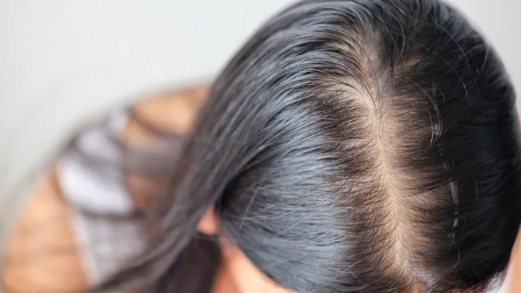 alopecia androgenetica