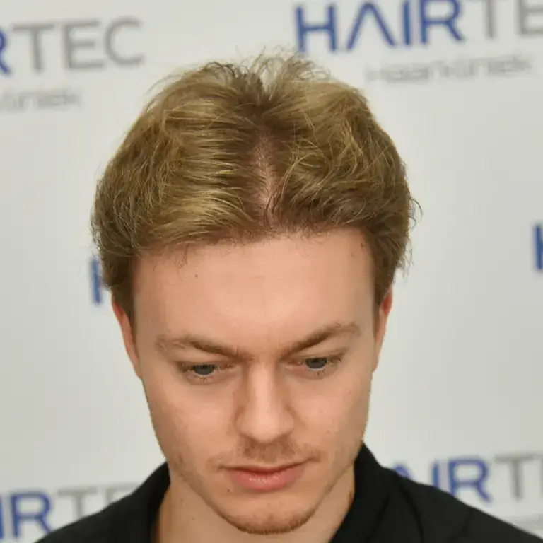 jurriaan voor en na photos na