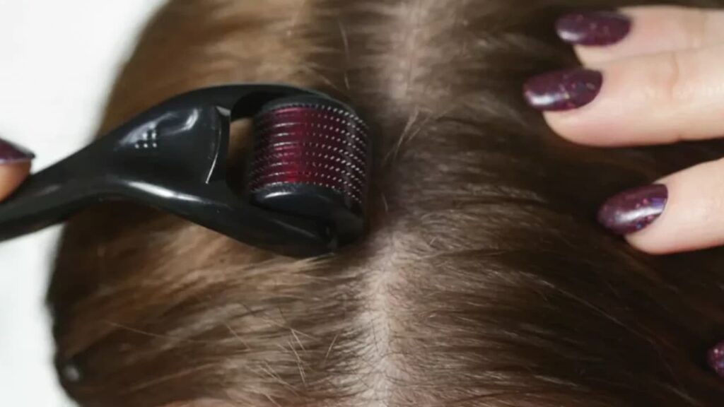 dermaroller haargroei