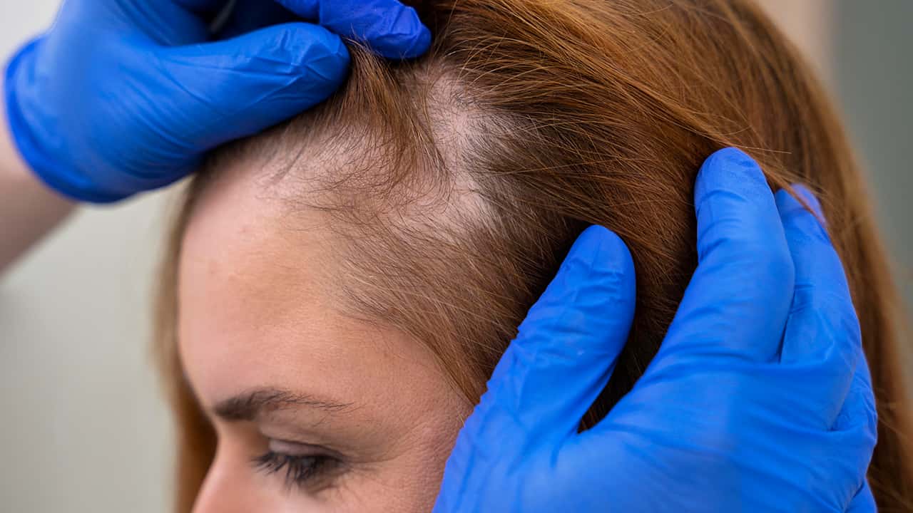 dun haar hoofdhuid te zien