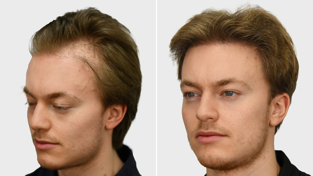 j-reiprich-voor-en-na.png-links