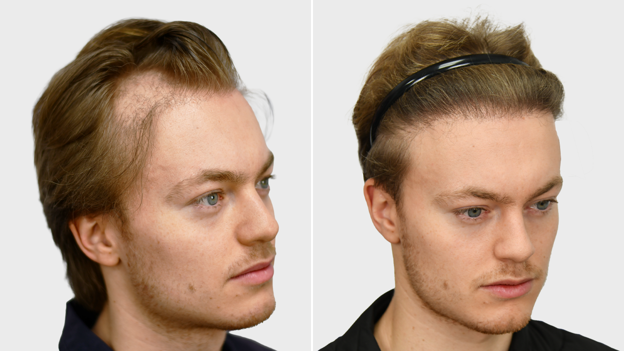j-reiprich-voor-en-na.png-rechts