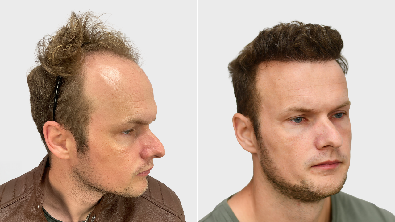k-klein-voor-en-na-rechts