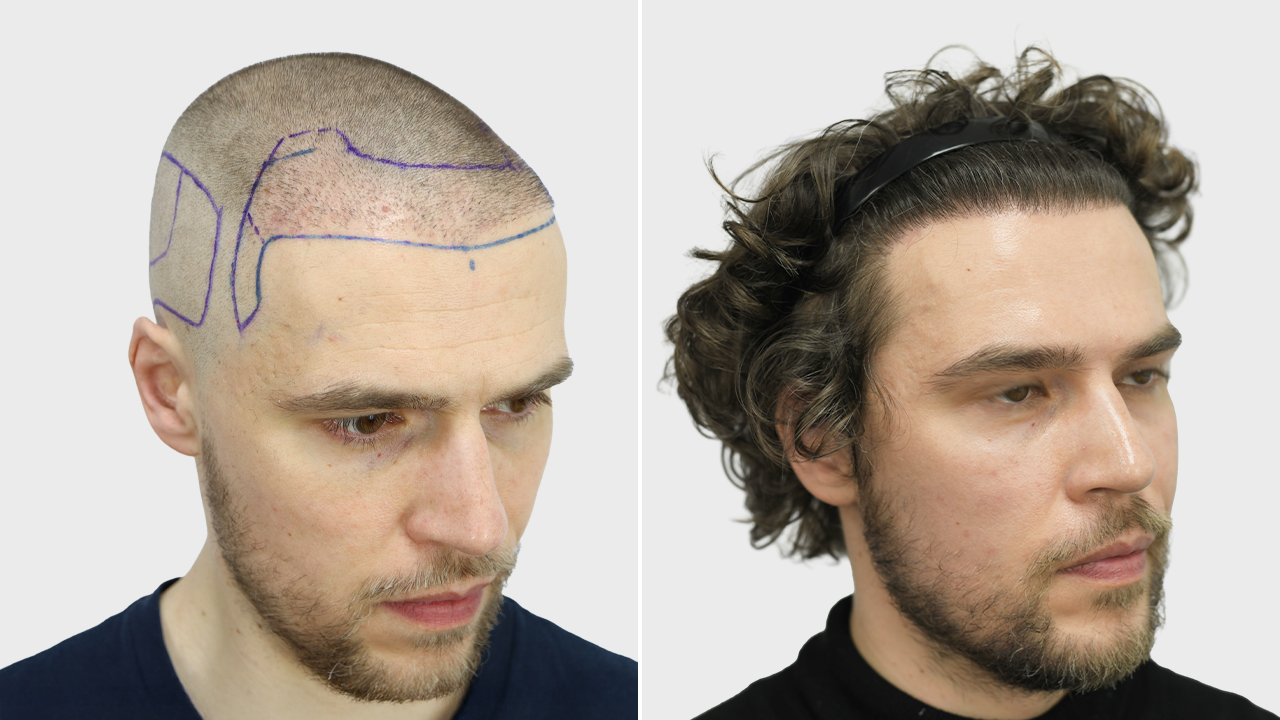p-bosma-voor-en-na-rechts
