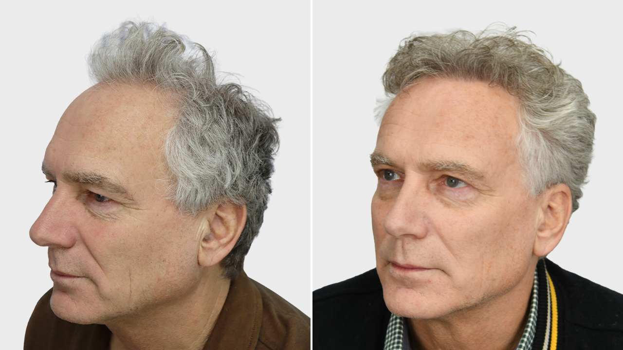 p-de-lange-voor-en-na-rechts
