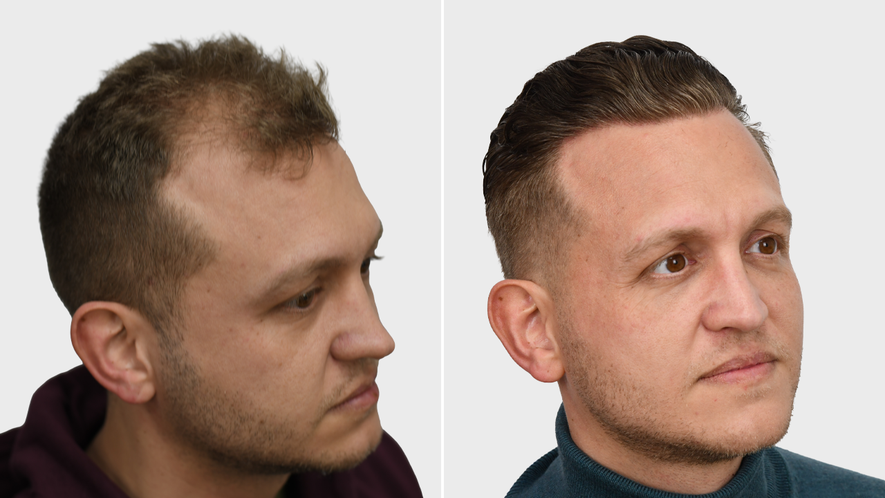 s-baars-voor-en-na-rechts