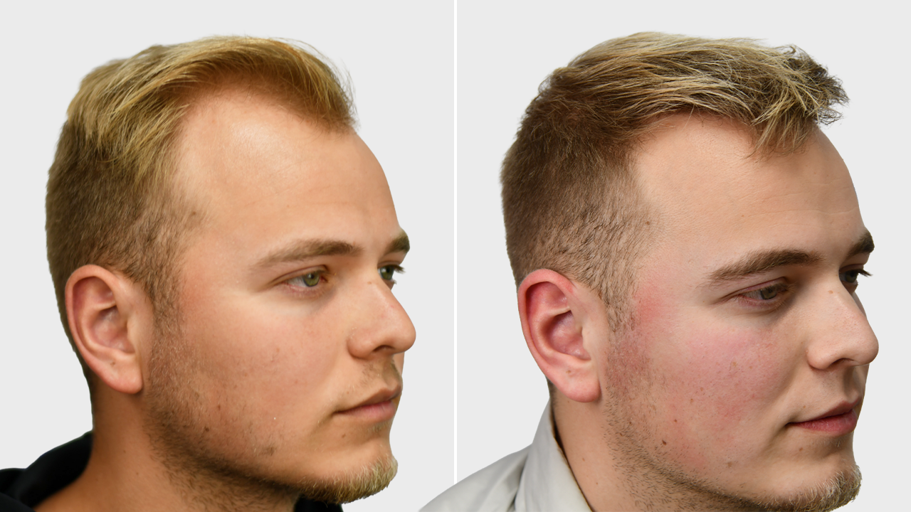t-goot-voor-en-na-rechts