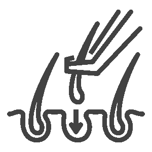 De meest verfijnde FUE techniek