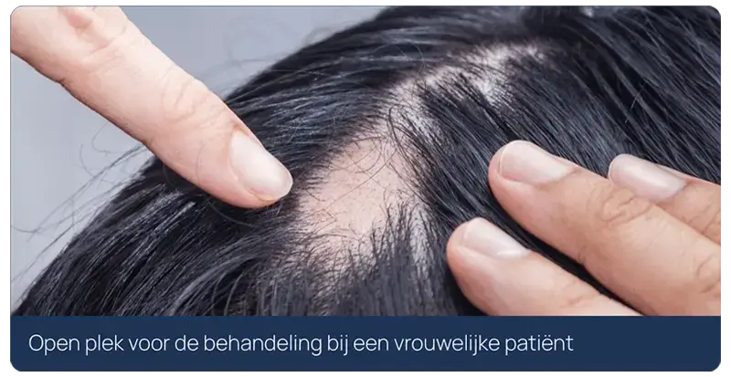open plek voor de haartransplantatie behandeling