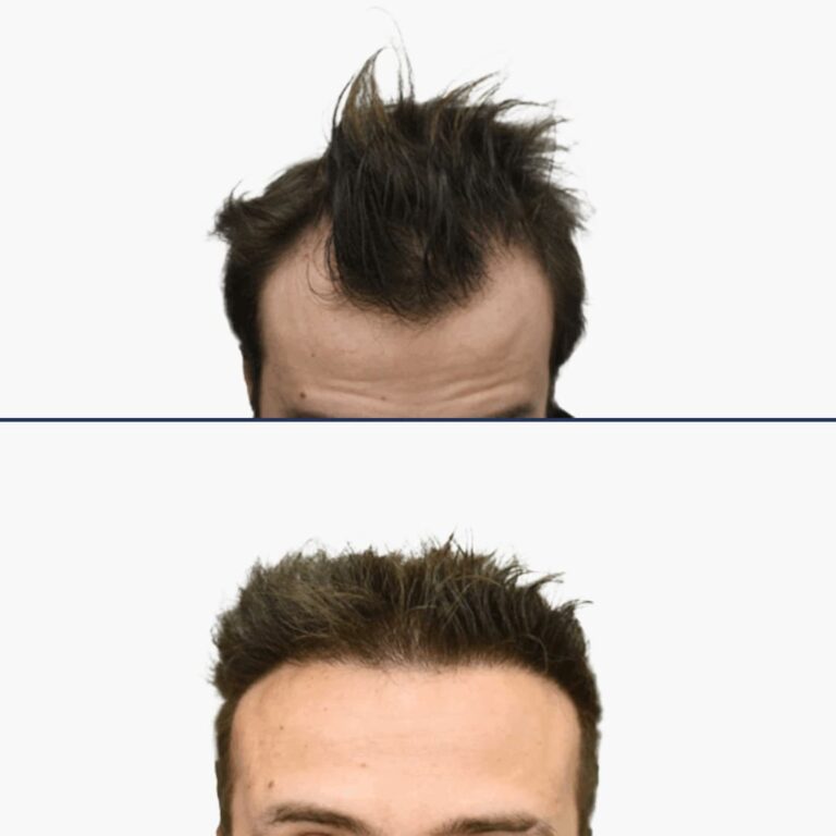 voor en na dhi mobile 3